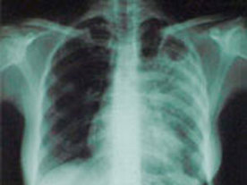 В Бишкеке за 11 месяцев 2011 года общая заболеваемость туберкулезом выросла на 5 %