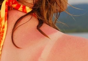 Как реабилитировать кожу после солнечного ожога – K-News