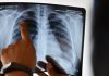 В Джалал-Абадской области больные туберкулезом хотят получать больше информации о своих правах