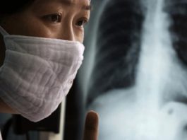 В Кыргызстане на лечение устойчивой формы туберкулеза необходимо $4-5 тыс.