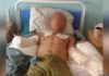 Пострадавшему от удара током в Майлуу-Суу солдату ампутируют вторую руку