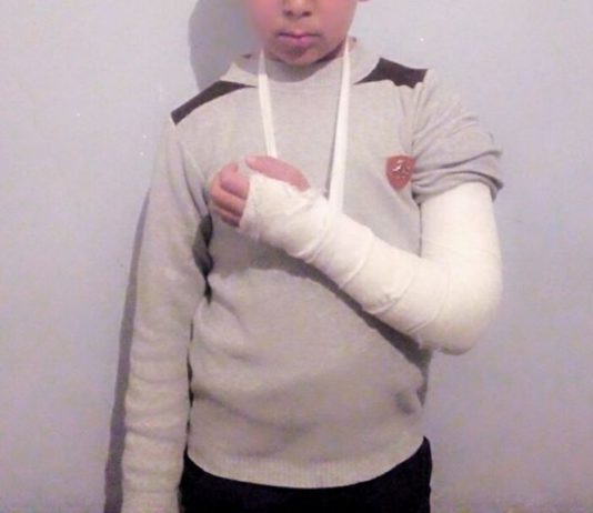 В Узбекистане учитель сломал руку пятикласснику палкой