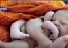 На востоке Индии родился ребенок с восемью конечностями. Две пары рук и ног