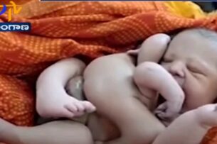 На востоке Индии родился ребенок с восемью конечностями. Две пары рук и ног
