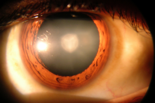 Новое революционное лечение катаракты показало положительные результаты