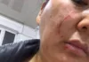 Конфликт в Кара-Жыгаче: Женщина из видео рассказала свою версию, показала ушибы и раны